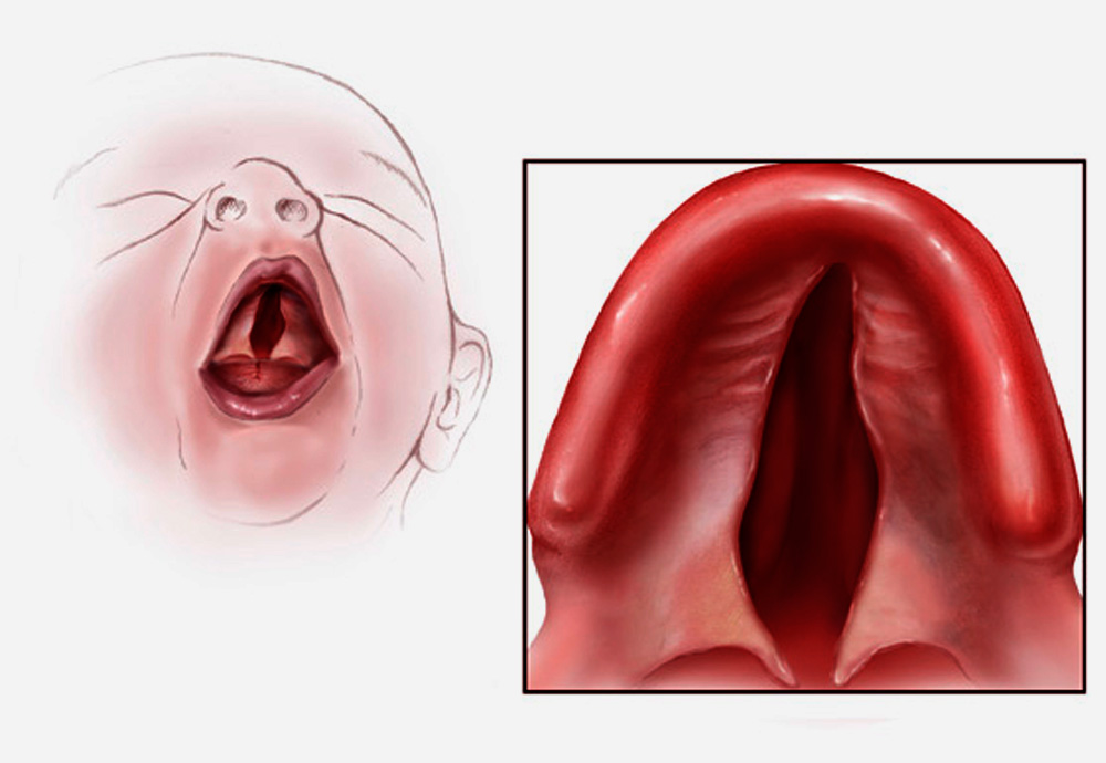 ¿Qué es el labio y paladar hendido?